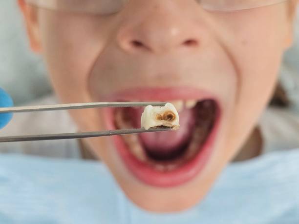 Best Emergency Dental Care for Broken or Chipped Teeth in Woodville, MS